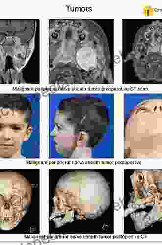 Pediatric Head And Neck Tumors: A Z Guide To Presentation And Multimodality Management